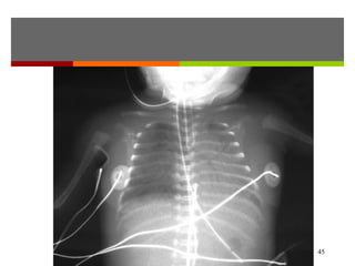 Management
Initiate ampicillin and gentamicin IV;
modify according to culture results
and continue therapy for 14 days.
If there is a fungal infection, an
antifungal agent is used.
 