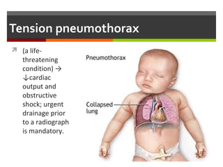 Chest x-ray: Right-sided pneumothorax
 