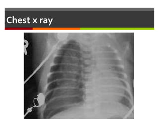 Right-sided tension pneumothorax with mediastinal shift. Both
lungs demonstrate opacification of alveolar collapse.
 