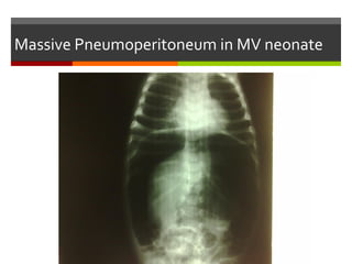 Others
Pneumomediastinum
 It can occur with aggressive ETT insertion, Ryle's feeding tube
insertion, lung disease, MV, or chest surgery (e.g., TEF).
Pneumopericardium
Pneumoperitoneum
Subcutaneous emphysema
Systemic air embolism
 