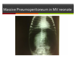 Massive Pneumoperitoneum in MV neonate
 