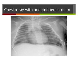 Chest x-ray with pneumopericardium
 