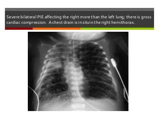 Severe bilateral PIE affecting the right more than the left lung; there is gross
cardiac compression. A chest drain is in situin the right hemithorax.
 