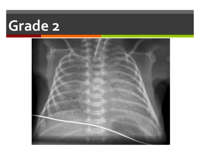 Neonatal Respiratory Distress