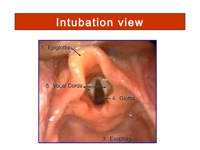 MILES TO READ B4 I SLEEP: NN ETT X CRICOID PRESSURE AND VOCAL CORDS
