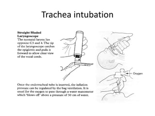 Trachea intubation

 