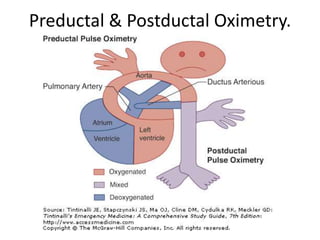 Preductal & Postductal Oximetry.
 
