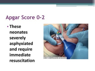 Apgar Score 0-2
• These
neonates
severely
asphyxiated
and require
immediate
resuscitation
 