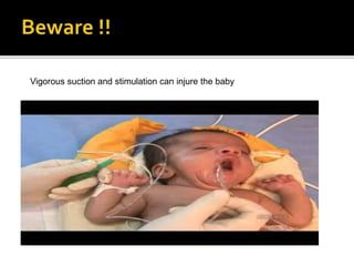 Vigorous suction and stimulation can injure the baby
 