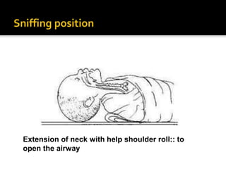 Extension of neck with help shoulder roll:: to
open the airway
 