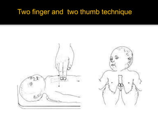 Two finger and two thumb technique
 