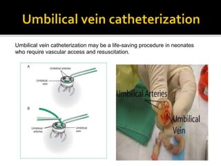 Umbilical vein catheterization may be a life-saving procedure in neonates
who require vascular access and resuscitation.
 