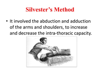 Silvester’s Method
• It involved the abduction and adduction
of the arms and shoulders, to increase
and decrease the intra-thoracic capacity.
 