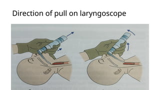 Direction of pull on laryngoscope
 