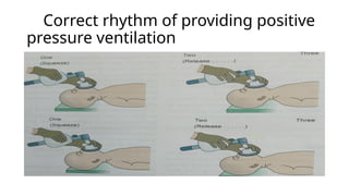 Correct rhythm of providing positive
pressure ventilation
 