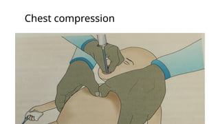 Chest compression
 