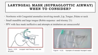 LARYNGEAL MASK (SUPRAGLOTTIC AIRWAY)
WHEN TO CONSIDER?
• Newborns with Congenital anomalies involving mouth ,Lip, Tongue ,Palate or neck
• Small mandible and large tongue (Robin sequence and trisomy 21)
• PPV with face mask ineffective and attempts at intubation are unsuccessful
 
