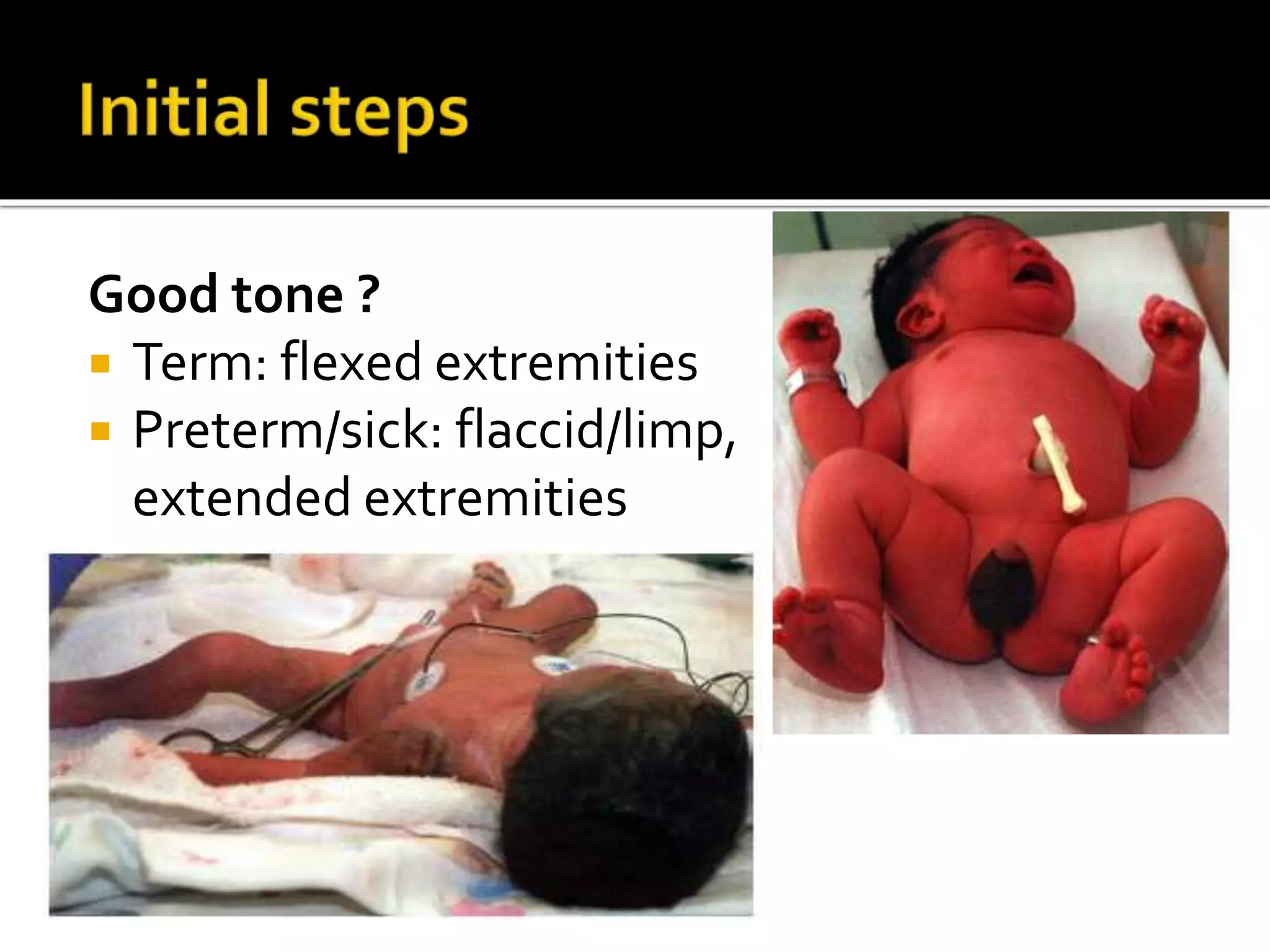 Good tone ?
 Term: flexed extremities
 Preterm/sick: flaccid/limp,
extended extremities
 
