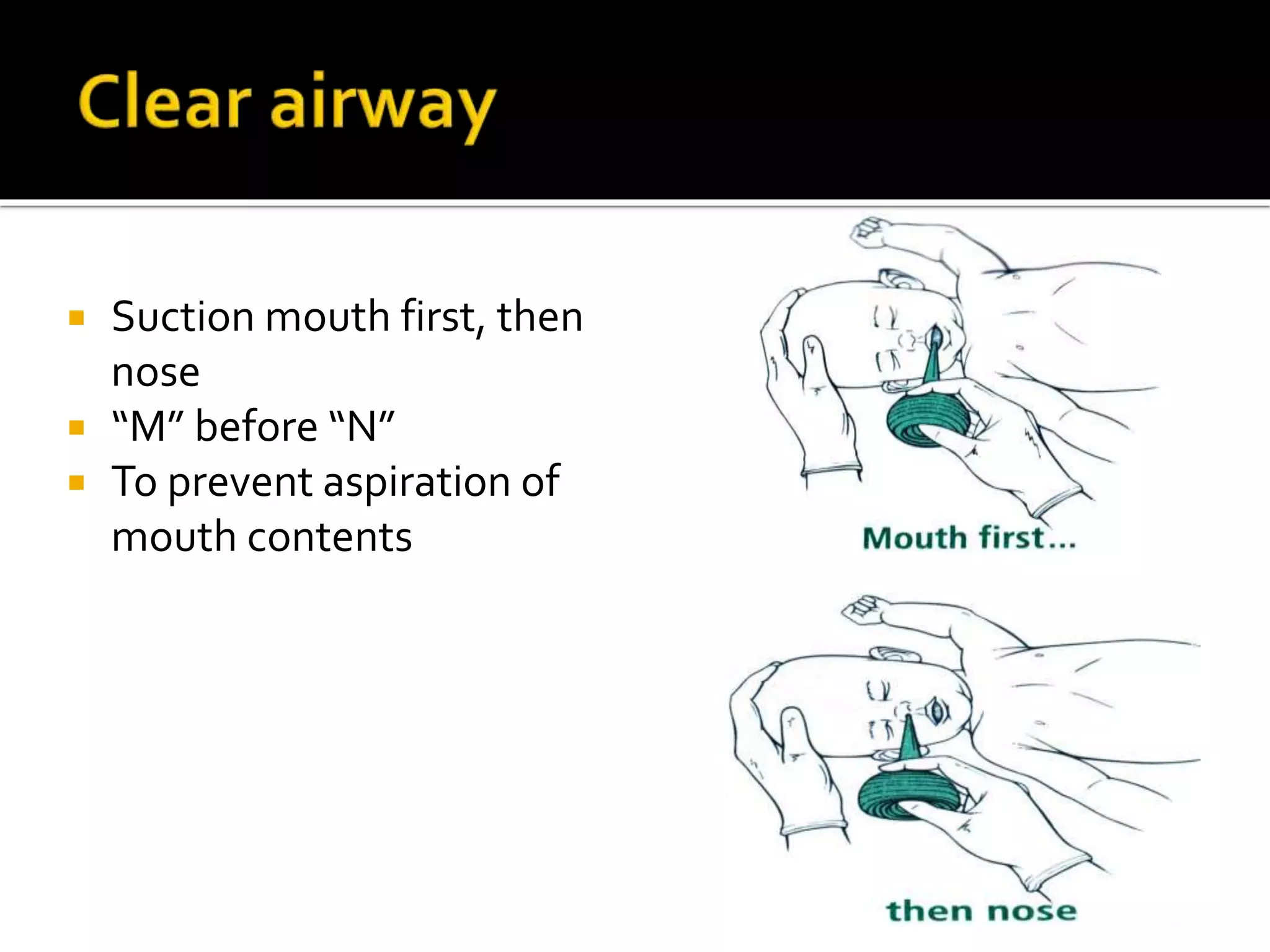  Suction mouth first, then
nose
 “M” before “N”
 To prevent aspiration of
mouth contents
 