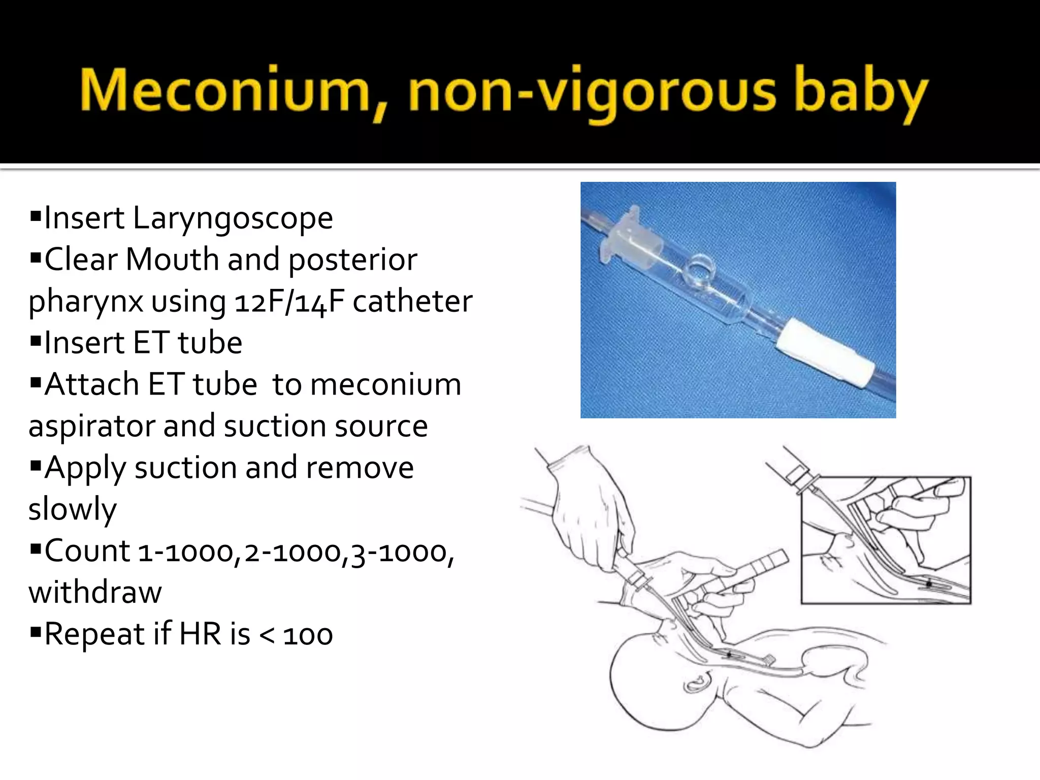 Insert Laryngoscope
Clear Mouth and posterior
pharynx using 12F/14F catheter
Insert ET tube
Attach ET tube to meconium
aspirator and suction source
Apply suction and remove
slowly
Count 1-1000,2-1000,3-1000,
withdraw
Repeat if HR is < 100
 