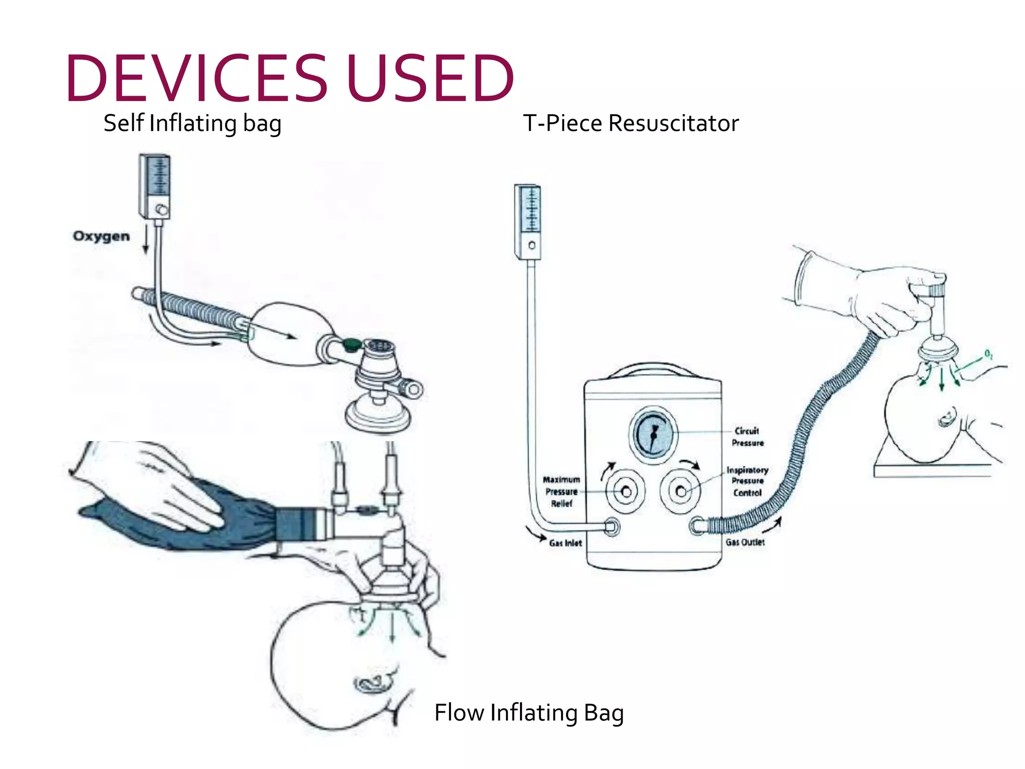 Self Inflating bag
Flow Inflating Bag
T-Piece Resuscitator
DEVICES USED
 