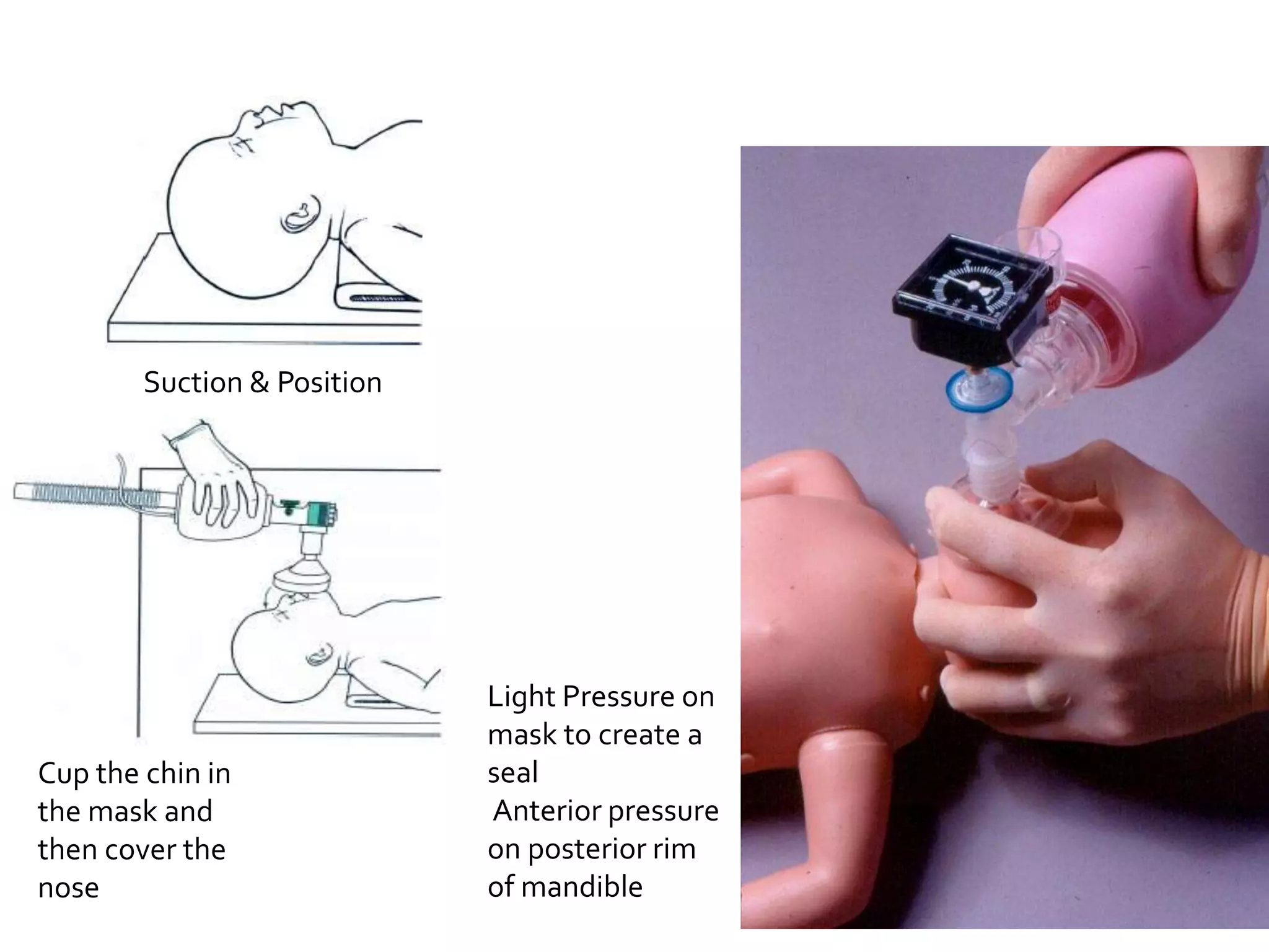 Suction & Position
Cup the chin in
the mask and
then cover the
nose
Light Pressure on
mask to create a
seal
Anterior pressure
on posterior rim
of mandible
 