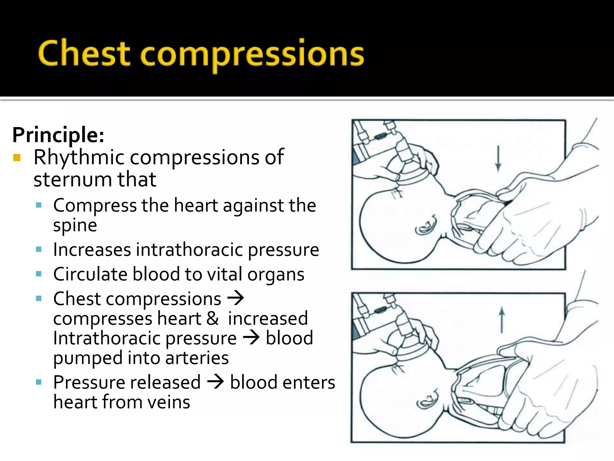 Principle:
 Rhythmic compressions of
sternum that
 Compress the heart against the
spine
 Increases intrathoracic pressure
 Circulate blood to vital organs
 Chest compressions 
compresses heart & increased
Intrathoracic pressure  blood
pumped into arteries
 Pressure released  blood enters
heart from veins
 