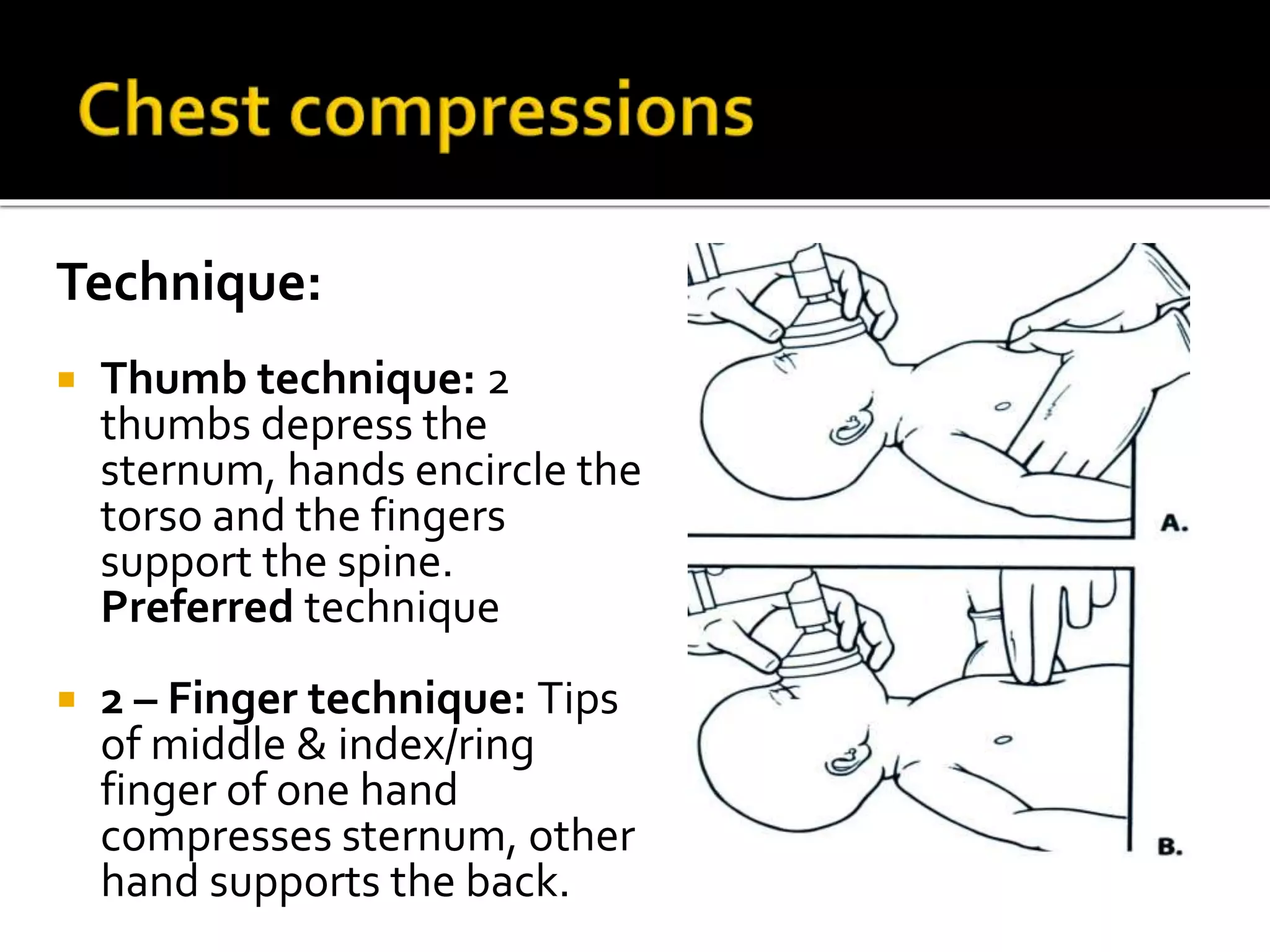 Technique:
 Thumb technique: 2
thumbs depress the
sternum, hands encircle the
torso and the fingers
support the spine.
Preferred technique
 2 – Finger technique: Tips
of middle & index/ring
finger of one hand
compresses sternum, other
hand supports the back.
 