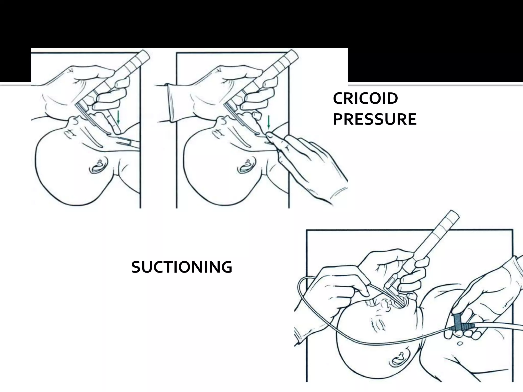 CRICOID
PRESSURE
SUCTIONING
 