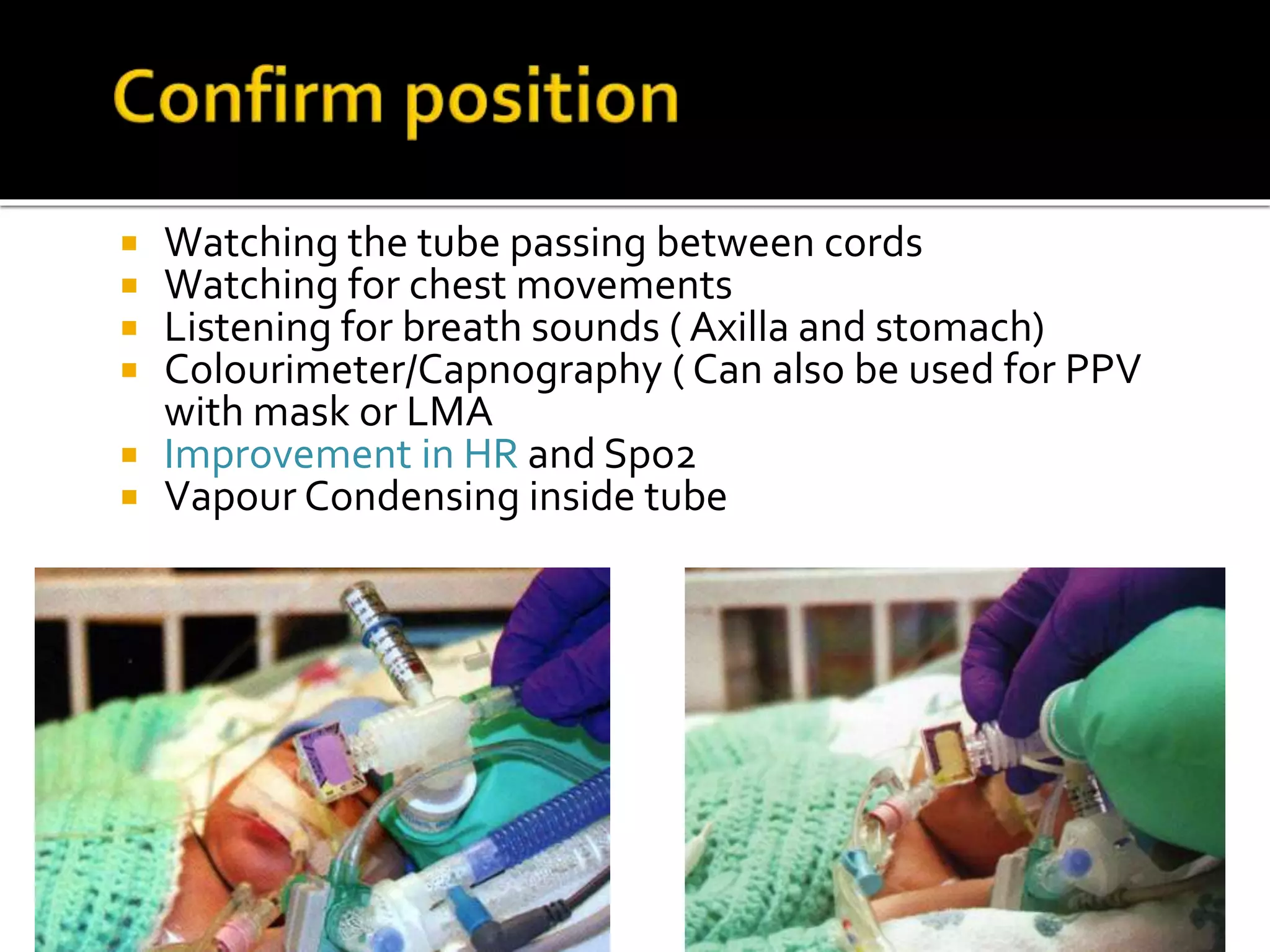  Watching the tube passing between cords
 Watching for chest movements
 Listening for breath sounds ( Axilla and stomach)
 Colourimeter/Capnography ( Can also be used for PPV
with mask or LMA
 Improvement in HR and Spo2
 Vapour Condensing inside tube
 