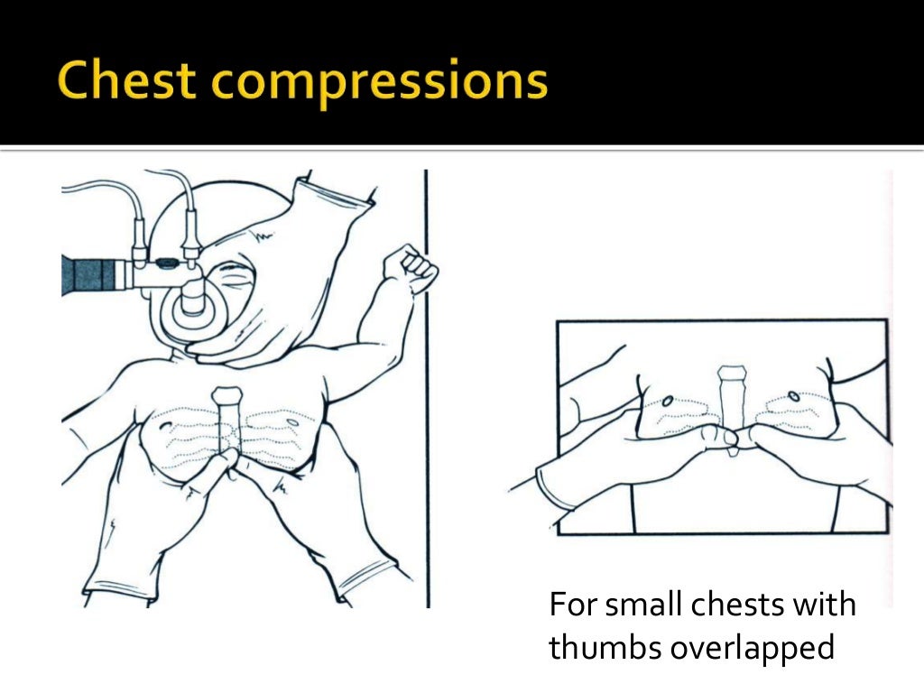 Neonatal resuscitation programme, NRP