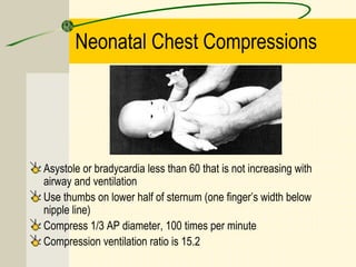 Neonatal Chest Compressions
Asystole or bradycardia less than 60 that is not increasing with
airway and ventilation
Use thumbs on lower half of sternum (one finger’s width below
nipple line)
Compress 1/3 AP diameter, 100 times per minute
Compression ventilation ratio is 15.2
 