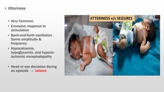 ▪ Jitteriness
▪ Very Common
▪ Excessive response to
stimulation
▪ Back-and-forth oscillation ,
Same amplitude &
frequency
▪ Hypocalcemia,
hypoglycemia, and hypoxic-
ischemic encephalopathy
▪ Head or eye deviation during
an episode → seizure
 