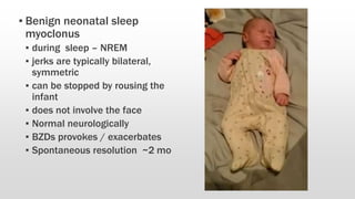 ▪ Benign neonatal sleep
myoclonus
▪ during sleep – NREM
▪ jerks are typically bilateral,
symmetric
▪ can be stopped by rousing the
infant
▪ does not involve the face
▪ Normal neurologically
▪ BZDs provokes / exacerbates
▪ Spontaneous resolution ~2 mo
 