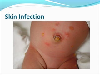 Neonatal sepsis | PPT