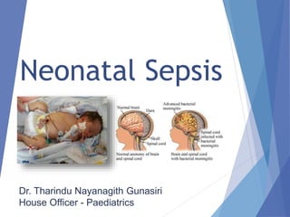 Neonatal Sepsis
Dr. Tharindu Nayanagith Gunasiri
House Officer - Paediatrics
 