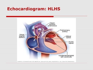 Echocardiogram: HLHS
 
