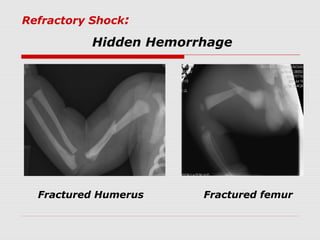 Refractory Shock:
Hidden Hemorrhage
Fractured Humerus Fractured femur
 