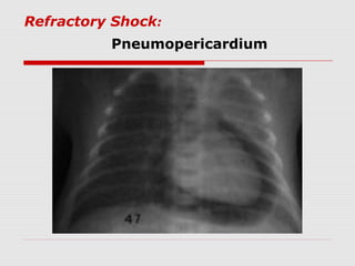 Refractory Shock:
Pneumopericardium
 