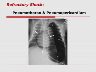 Refractory Shock:
Pneumothorax & Pneumopericardium
 