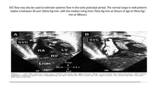 Neonatal shock and its management and advances | PPTX