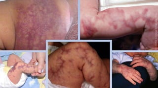 Neonatal Skincare and Dermatoses: From Physiology to Clinical ...