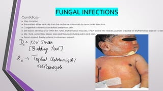 FUNGAL INFECTIONS
 