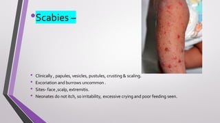 •Scabies –
• Clinically , papules, vesicles, pustules, crusting & scaling.
• Excoriation and burrows uncommon .
• Sites- face ,scalp, extremitis.
• Neonates do not itch, so irritability, excessive crying and poor feeding seen.
 