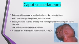 Caput succedaneum
• Extracranialinjury due to mechanical forces during parturition.
• Associated with prolong labour, vacuumdelivery.
• Boggy, localized swelling on scalp with varying degree of bruising and tissue
necrosis.
• Site most commonly occipital midline.
• It crossed the midline and resolve within 48 hours.
 