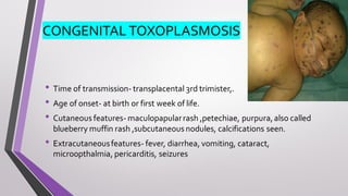 CONGENITAL TOXOPLASMOSIS
• Time of transmission- transplacental 3rd trimister,.
• Age of onset- at birth or first week of life.
• Cutaneous features- maculopapularrash ,petechiae, purpura,also called
blueberry muffin rash ,subcutaneous nodules, calcifications seen.
• Extracutaneousfeatures- fever, diarrhea, vomiting, cataract,
microopthalmia, pericarditis, seizures
 