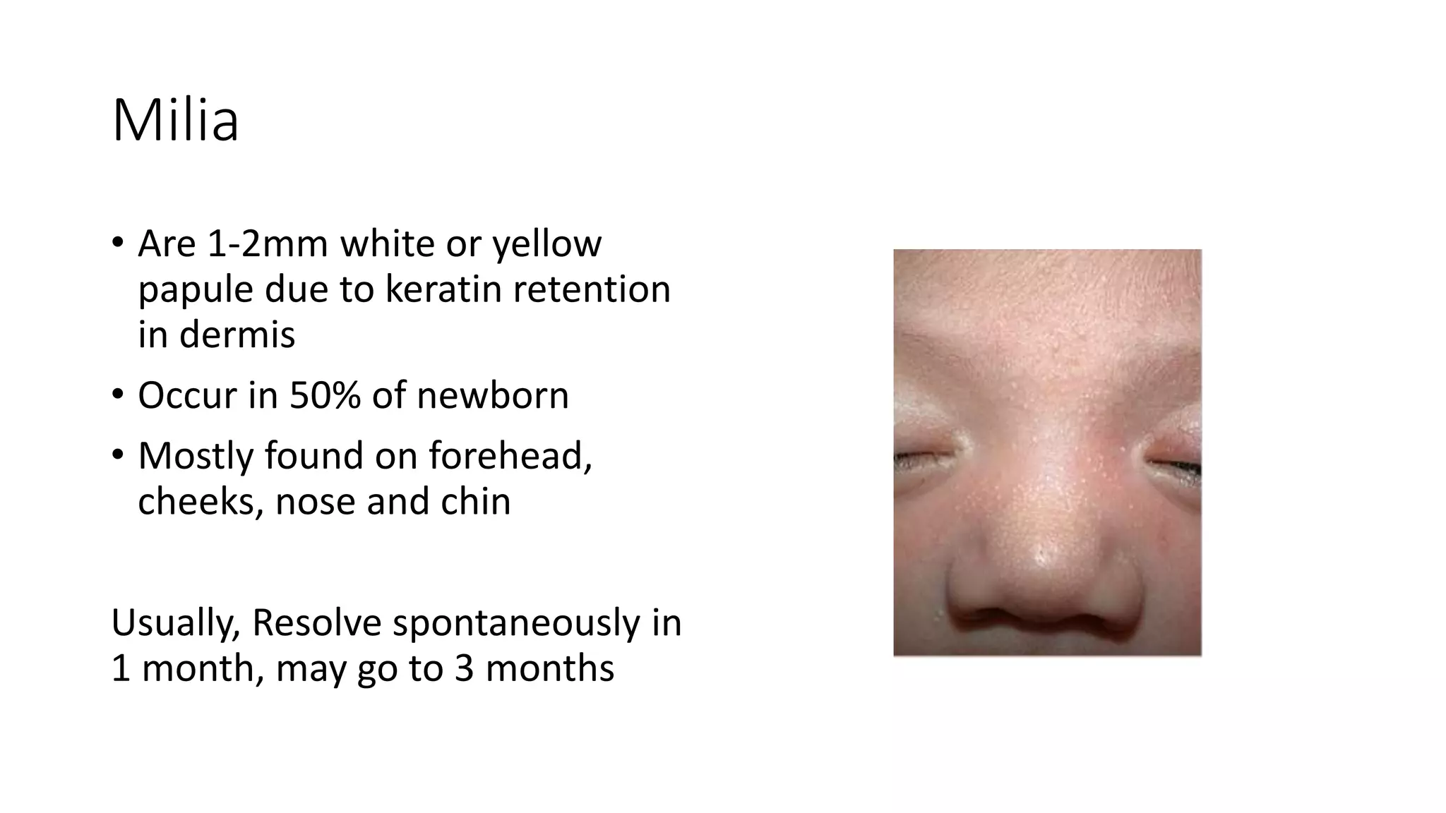 Milia
• Are 1-2mm white or yellow
papule due to keratin retention
in dermis
• Occur in 50% of newborn
• Mostly found on forehead,
cheeks, nose and chin
Usually, Resolve spontaneously in
1 month, may go to 3 months
 