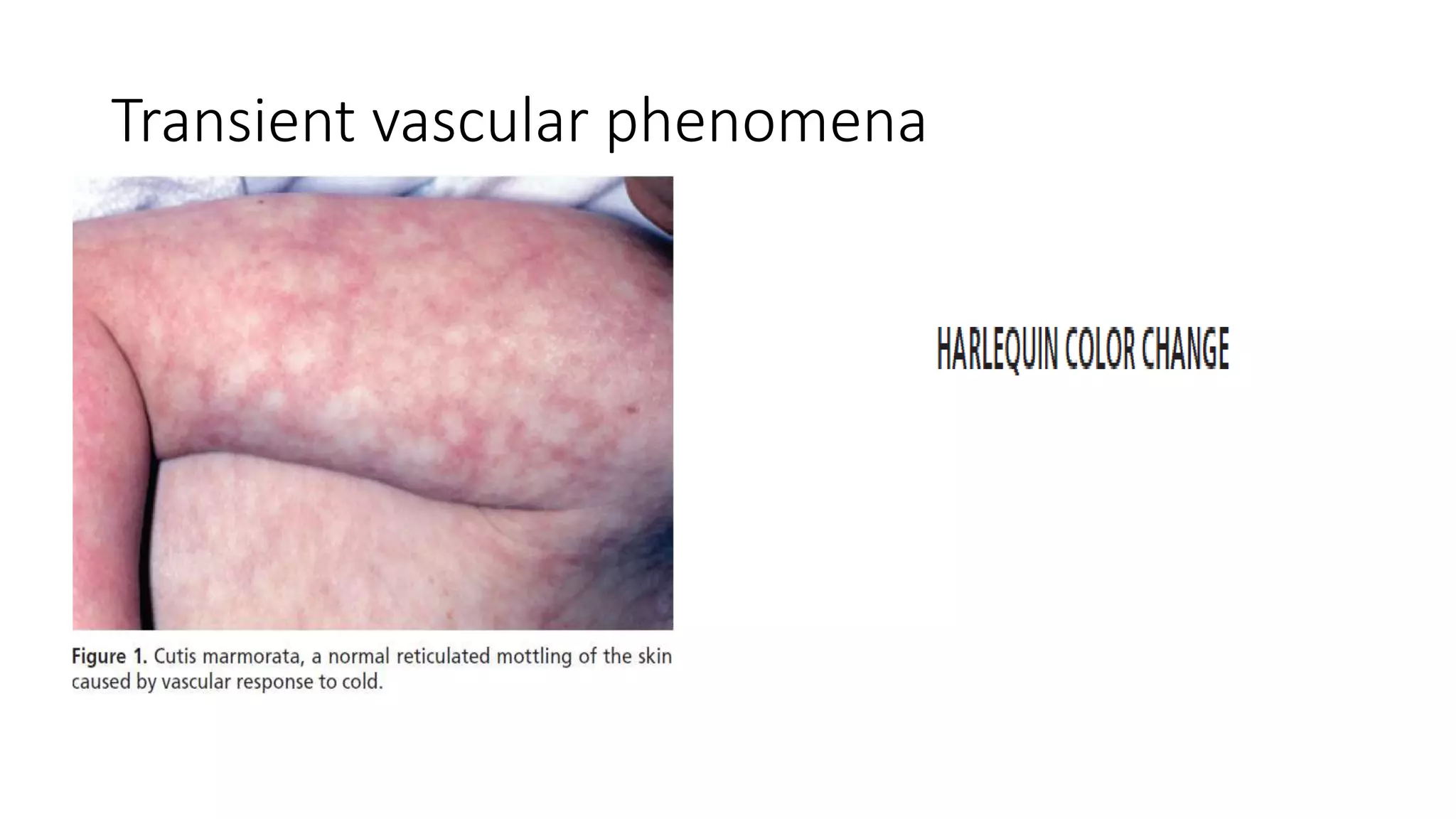 Transient vascular phenomena
 
