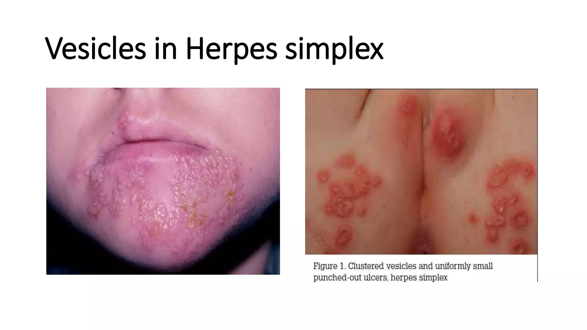 Vesicles in Herpes simplex
 