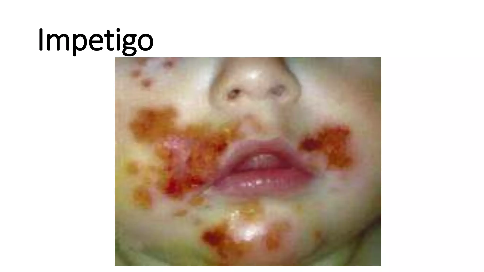Impetigo
 